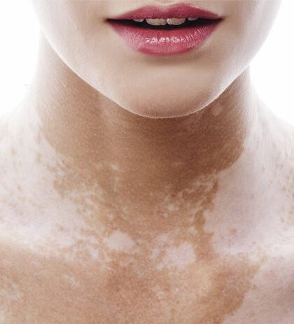 tratamiento del vitiligo