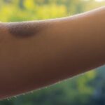 Persona con mancha en el brazo