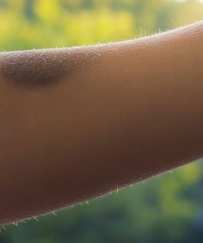 Persona con mancha en el brazo